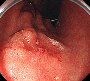 早期胃がん（粘膜下層浸潤がん）