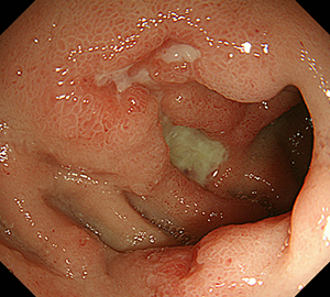 多発性十二指腸潰瘍