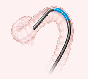 受動弯曲機能によって、生理的腸管弯曲部でも苦痛なくスコープが進みます。