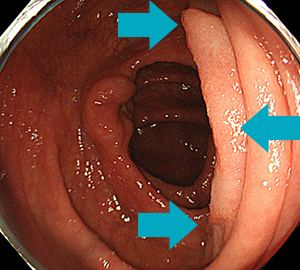 上行結腸に局在する早期大腸がん（左奥は正常な回盲弁）