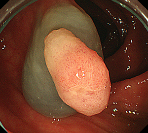 2：ポリープ直下の粘膜下層に局注液を注入します。