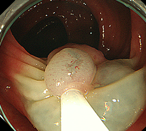 3：ポリープをスネアに通し、周囲の正常粘膜を入れて病変を絞扼し…