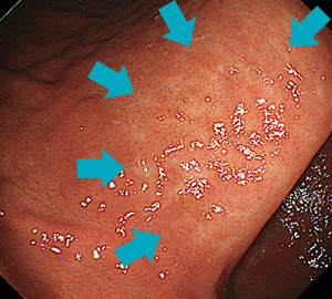 ピロリ菌感染による萎縮性胃炎（B型胃炎）。矢印部分が萎縮境界です。