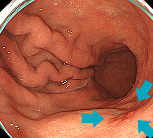 ピロリ菌感染胃に発生した早期胃がんです。
