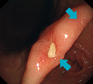 再生上皮を伴った胃潰瘍です。近傍に別病変の治癒過程像も見られます。