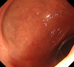 十二指腸球部前面潰瘍瘢痕での引き攣れによる上面の浅いポケット形成。