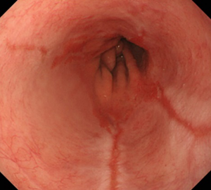 食道裂孔ヘルニアに伴った逆流性食道炎（LA分類グレードB）