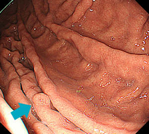胃底腺ポリープ