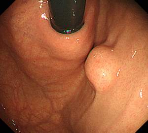 こちらは胃噴門部近傍のφ10mm大の病変です