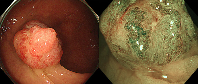 進行大腸がん（右はNBI拡大観察像）