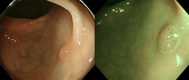 大腸腺腫（右はNBI拡大観察像）