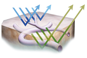 NBIによる血管および表面構造の明瞭化