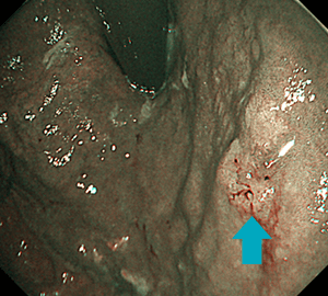 NBI観察で明瞭化します。