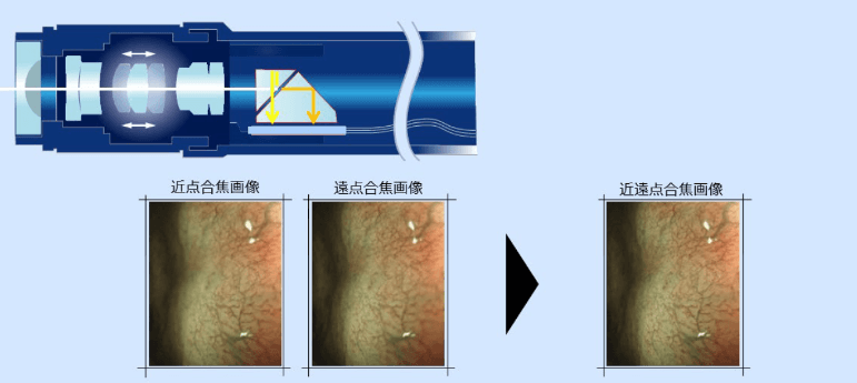 短時間・高精度の内視鏡検査に役立つEDOF