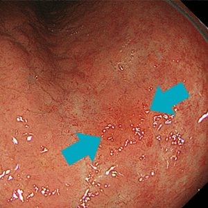 通常光（白色光）観察ではやや不明瞭な早期胃がん病変ですが