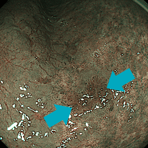 NBI観察では明瞭化しています。