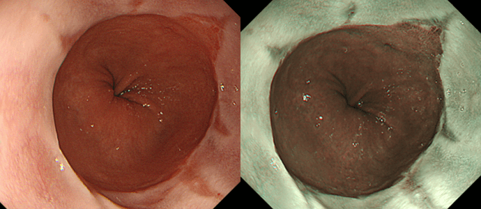 逆流性食道炎（右はNBI観察像）