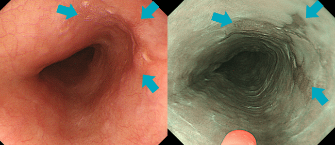 早期食道がん（右のNBI観察では明瞭化）