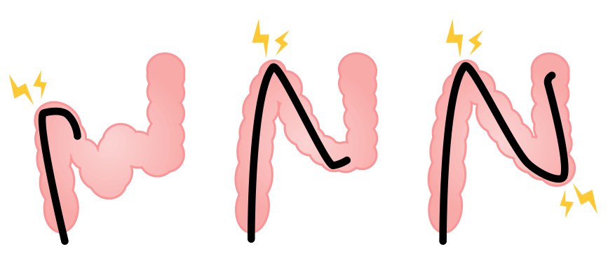 一般的に行われている挿入法（ループ挿入法）