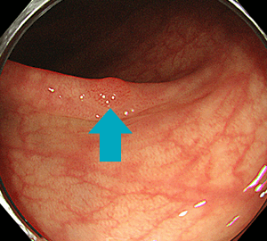 通常光（白色光）観察ではややはっきりしないポリープですが…