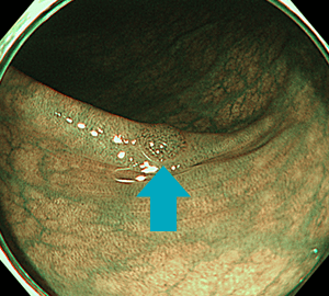NBI観察によって明瞭化し…