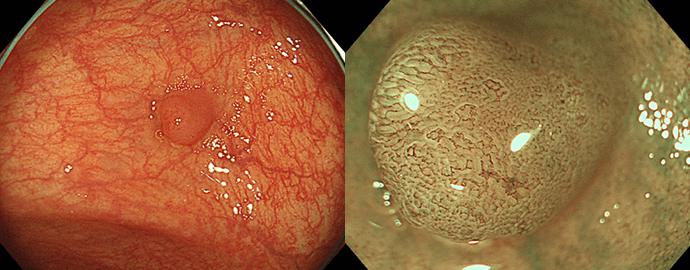 大腸腺腫（右はNBI併用拡大観察像）