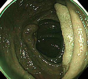 その病変のNBI観察像です。これを拡大して観察すると…