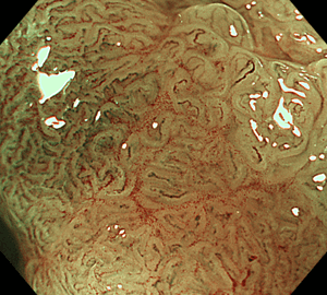 不整な表面構造と、血管の分布不均一・口径不同・蛇行を認めます。