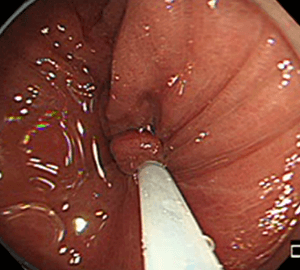 4：周囲の正常粘膜をしっかり入れながら、病変を絞扼していき…