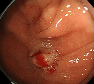 5：切除します。切除検体は吸引回収し、病理検査を行います