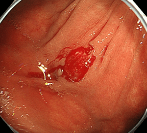 6：切除後に洗浄・観察して、病変の遺残がないことを確認します。
