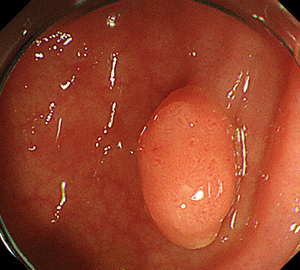 1：ポリープを見つけ、NBI併用拡大観察をした後…