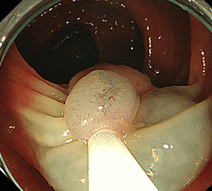 3：ポリープをスネアに通し、周囲の正常粘膜を入れて病変を絞扼し…