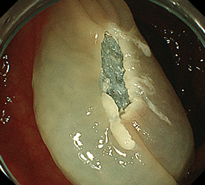 4：通電して切除し、周囲を観察して病変の遺残がないことを確認します。