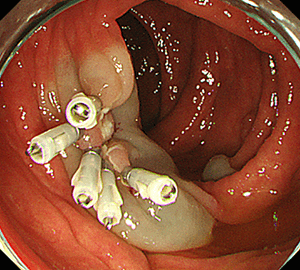 5：切除面をクリップで縫合閉鎖し、回収した検体の病理検査を行います。