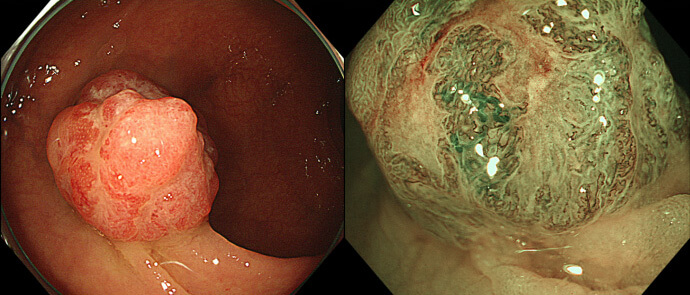進行大腸がん（右はNBI拡大観察像）
