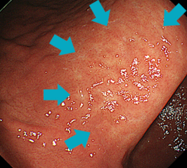 ピロリ菌感染による萎縮性胃炎（B型胃炎）。矢印部分が萎縮境界です。
