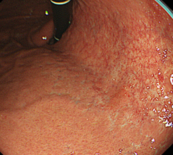 萎縮は前庭部から始まり、数十年単位で小弯側を口側へ進んでいきます。