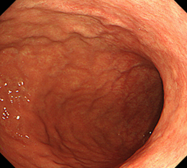 さらに進行すると、萎縮は前壁・後壁から大弯側へと広がっていきます。