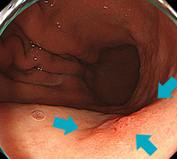 その病変の近接像です。