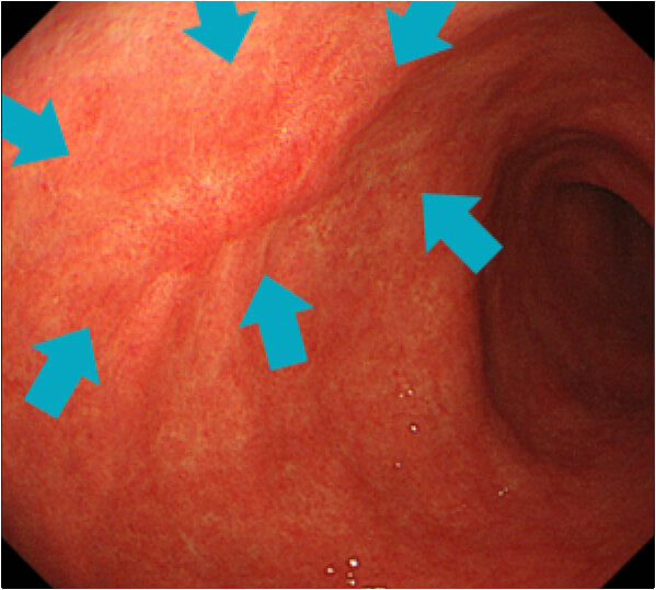 潰瘍は治癒するとこのように瘢痕化します。
