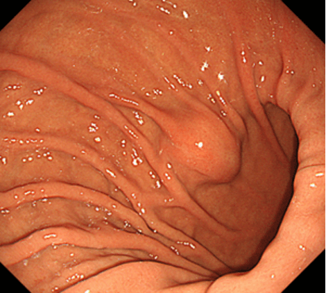 体下部大弯前壁寄りのφ15mm大のSEL