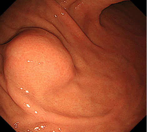 体下部大弯前壁寄りのφ15mm大のSEL