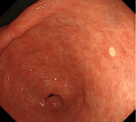 胃前庭部後壁の黄色腫