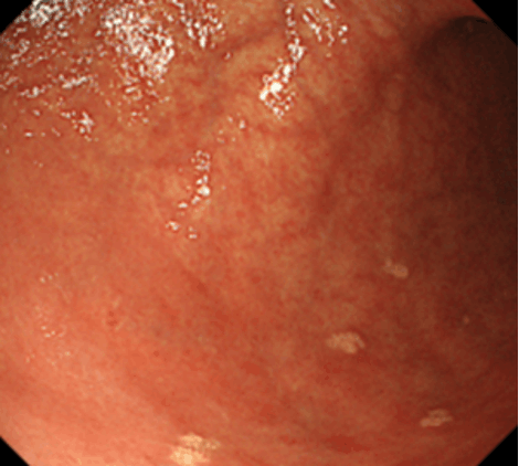 多発した胃黄色腫