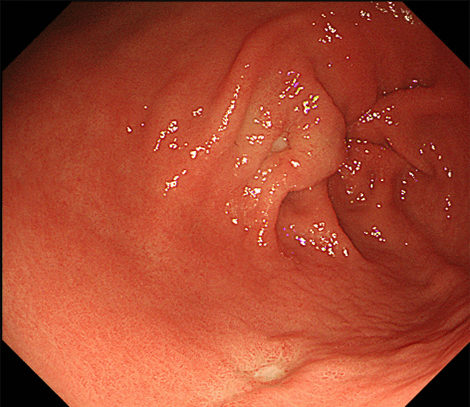 前庭部の多発胃潰瘍症例
