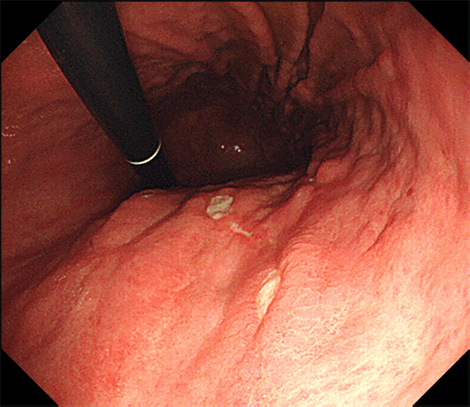 体部の多発胃潰瘍症例