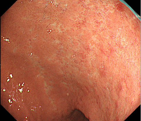 ピロリ菌に起因した胃体部小弯の粘膜萎縮