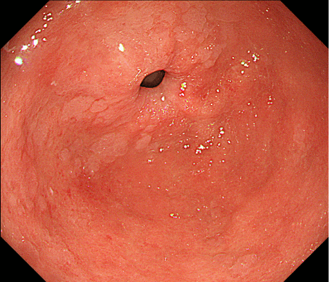 ピロリ菌由来の前庭部の粘膜萎縮と腸上皮化生
