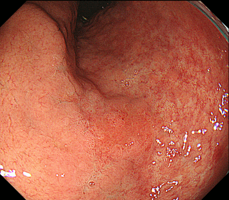 粘膜内にとどまる早期胃がん